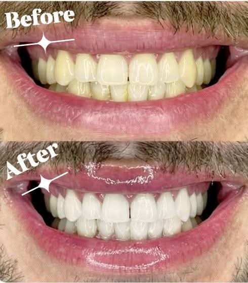 Real before and after teeth whitening — Occasion Glow · Kildare Town at Lumiere Kildare
