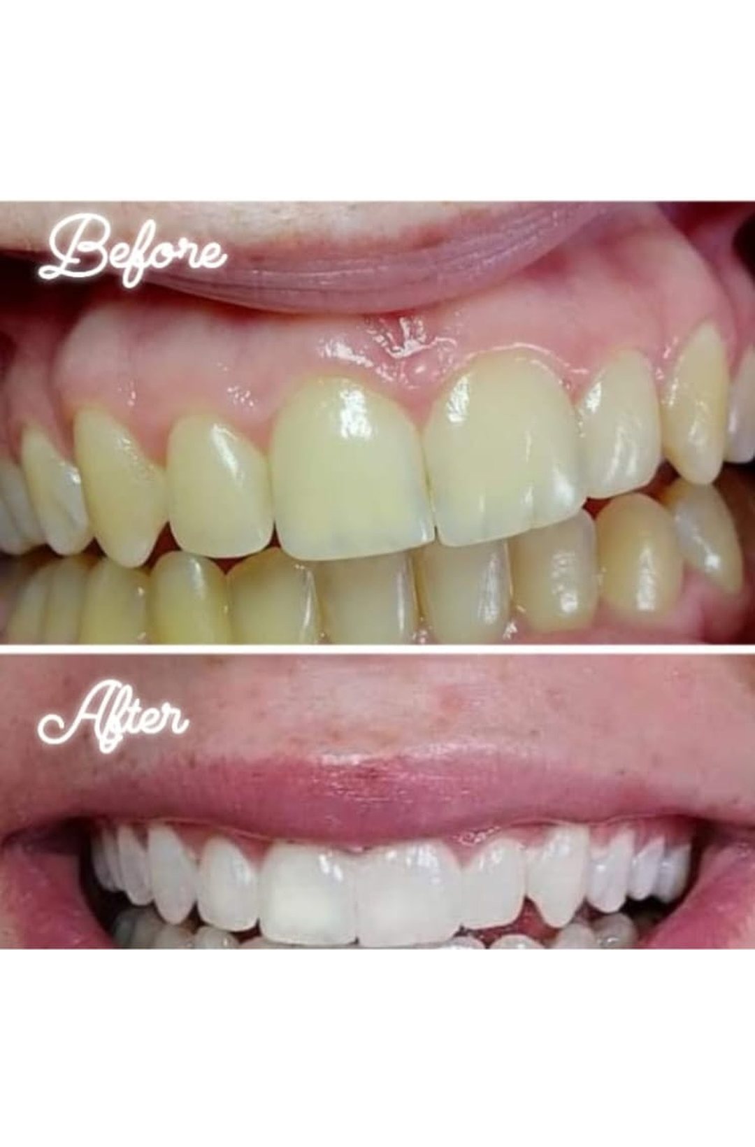 Lumiere teeth whitening before and after posted on Facebook as Teethwhitening Kildare on 2023. Braces removed — a beautiful smile.