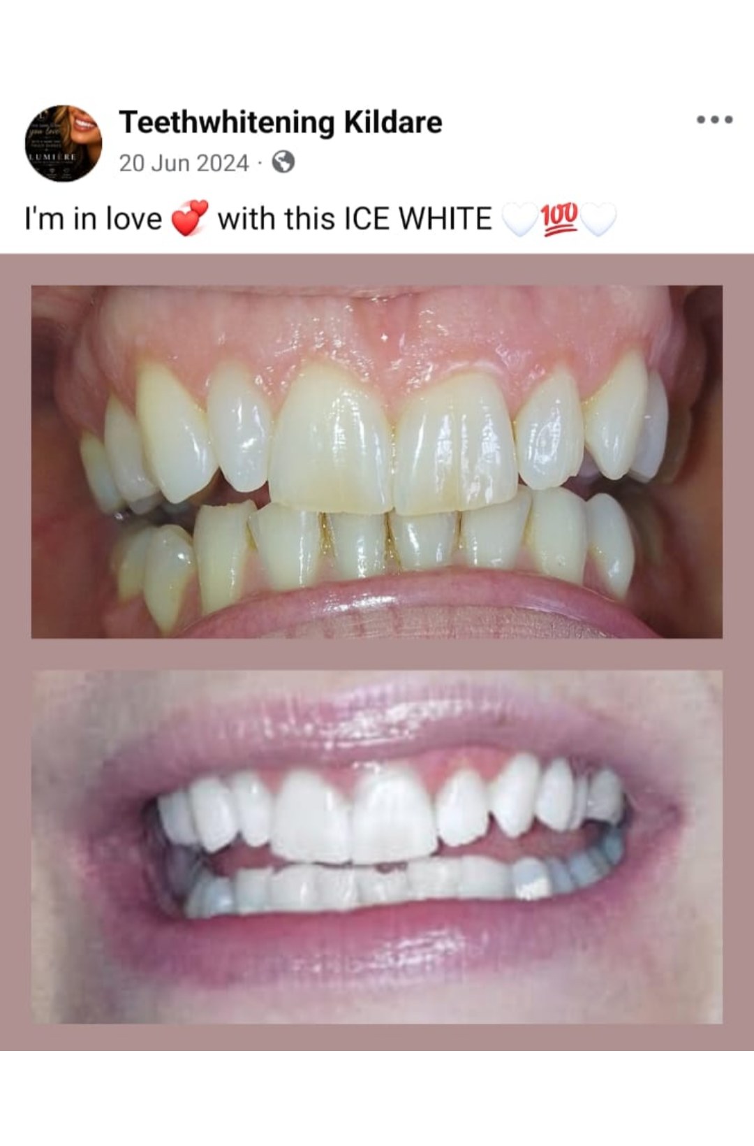 Lumiere teeth whitening before and after posted on Facebook as Teethwhitening Kildare on 20 Jun 2024. In love with this ice white result.