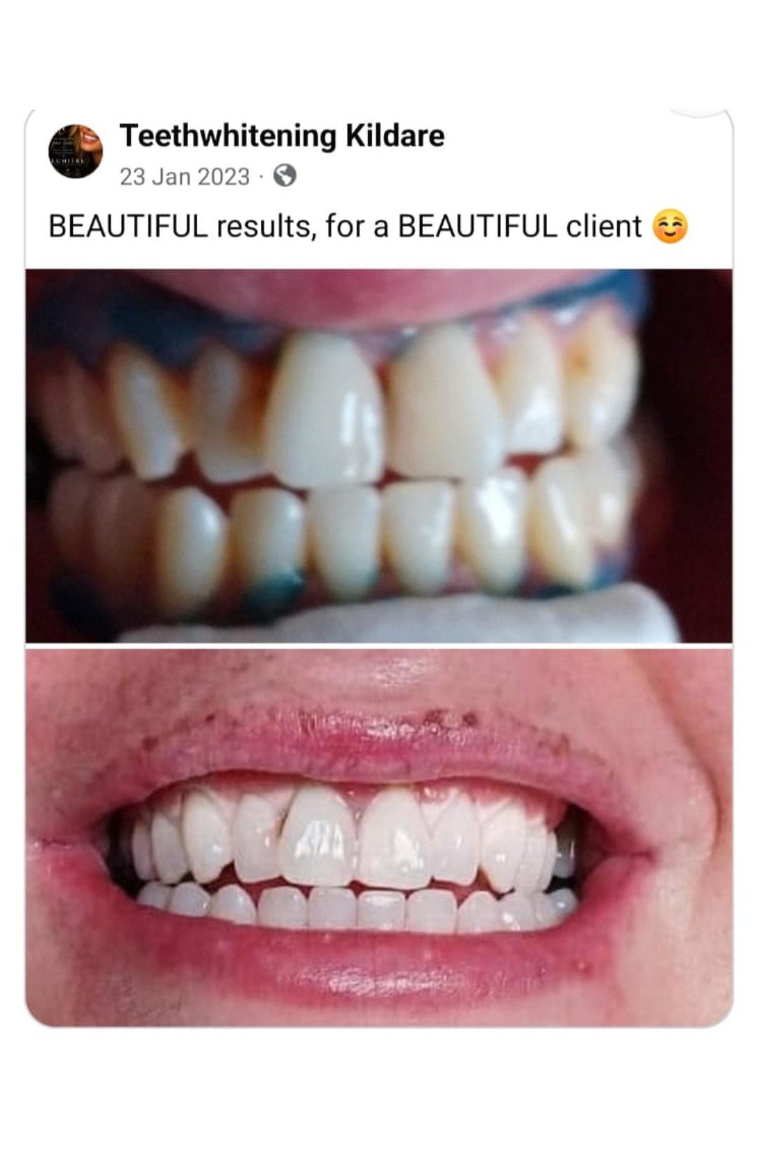 Lumiere teeth whitening before and after posted on Facebook as Teethwhitening Kildare on 23 Jan 2023. Beautiful results for a beautiful client.