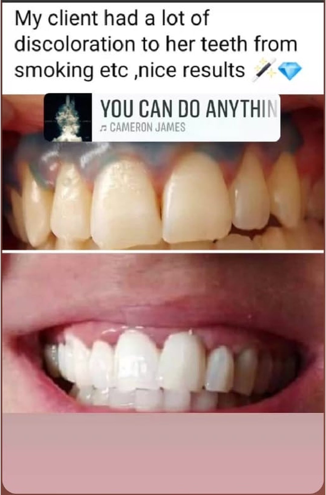 Lumiere teeth whitening before and after posted on Facebook as Teethwhitening Kildare on 1 Mar 2024. Heavy discoloration from smoking — nice results.