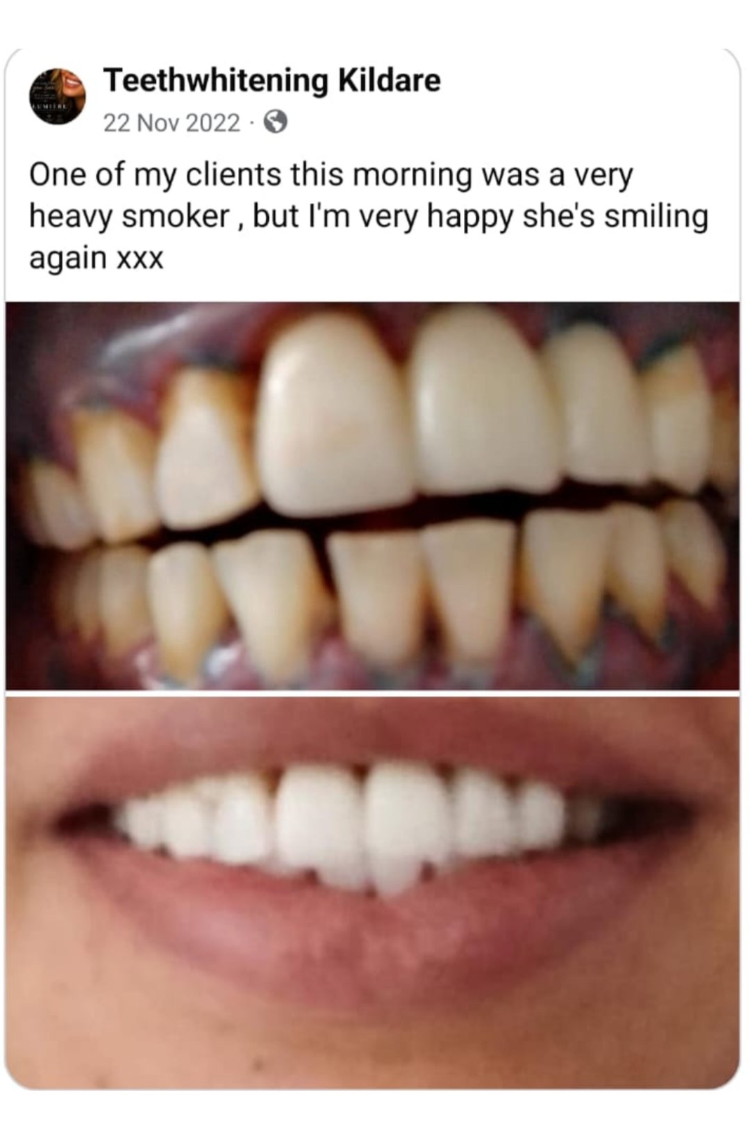 Lumiere teeth whitening before and after posted on Facebook as Teethwhitening Kildare on 22 Nov 2022. A heavy smoker's stains lifted — she's smiling again.