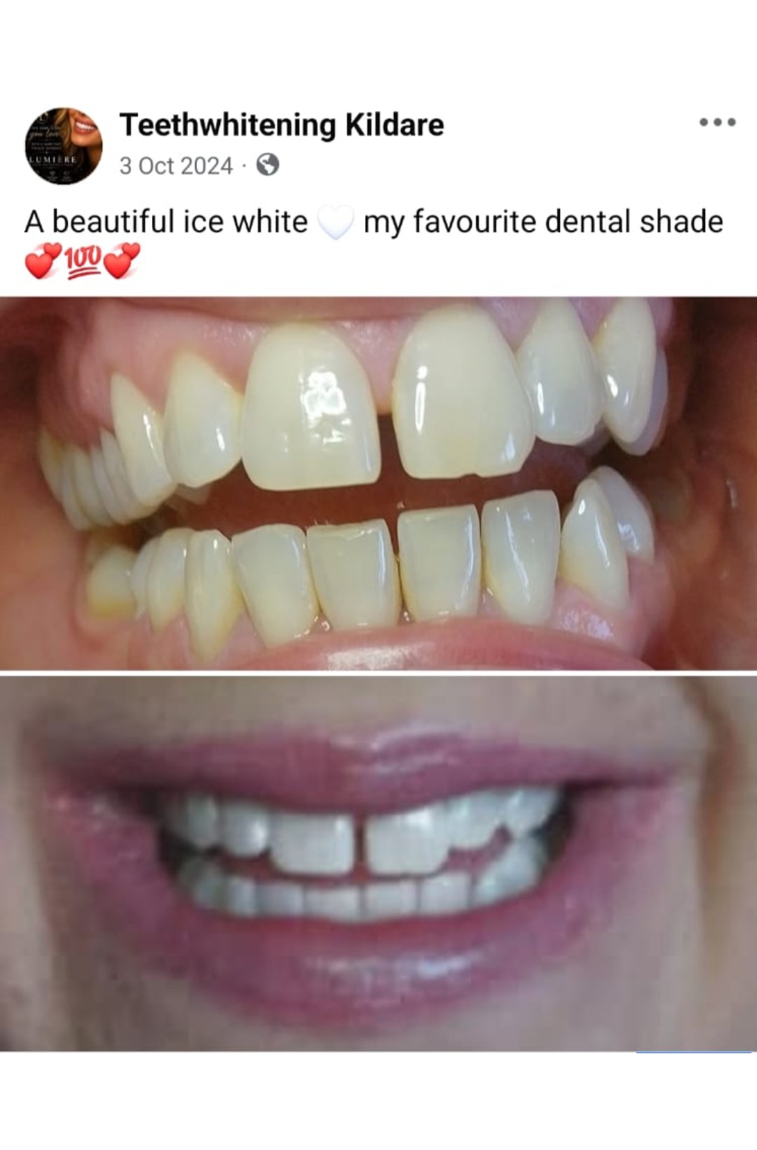 Lumiere teeth whitening before and after posted on Facebook as Teethwhitening Kildare on 3 Oct 2024. A beautiful ice white — Sharon's favourite dental shade.