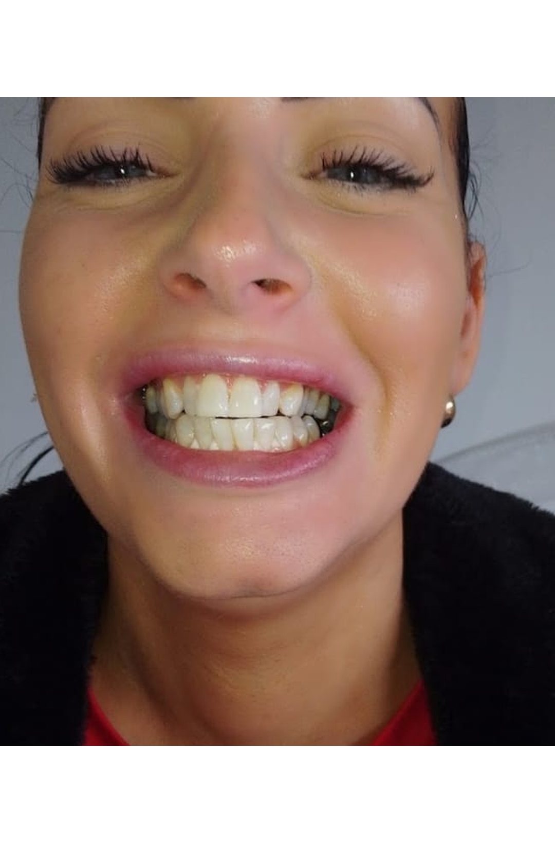Lumiere teeth whitening before and after posted on Facebook as Teethwhitening Kildare on 10 Dec 2025. Ice white and camera-ready.