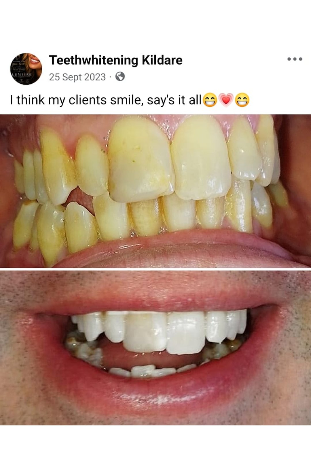 Lumiere teeth whitening before and after posted on Facebook as Teethwhitening Kildare on 25 Sept 2023. "I think my client's smile says it all."