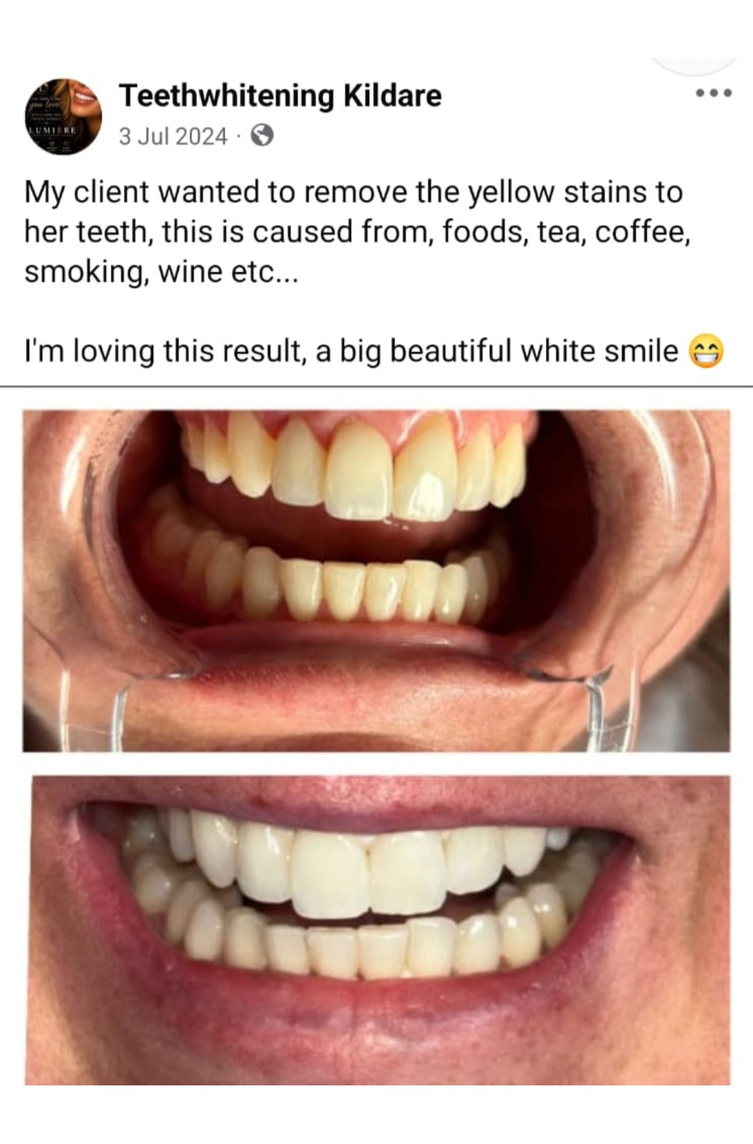 Lumiere teeth whitening before and after posted on Facebook as Teethwhitening Kildare on 3 Jul 2024. Yellow staining lifted — a big, beautiful white smile.