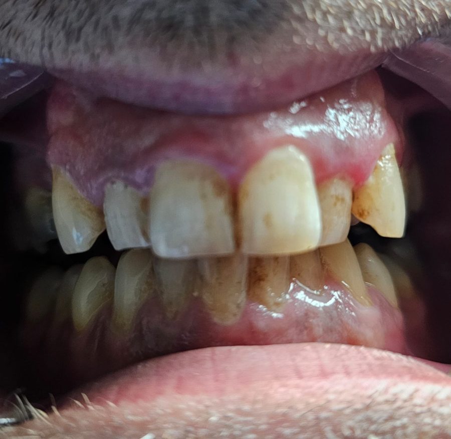 Before teeth whitening at Lumiere — client who was a heavy smoker and tea and coffee drinker