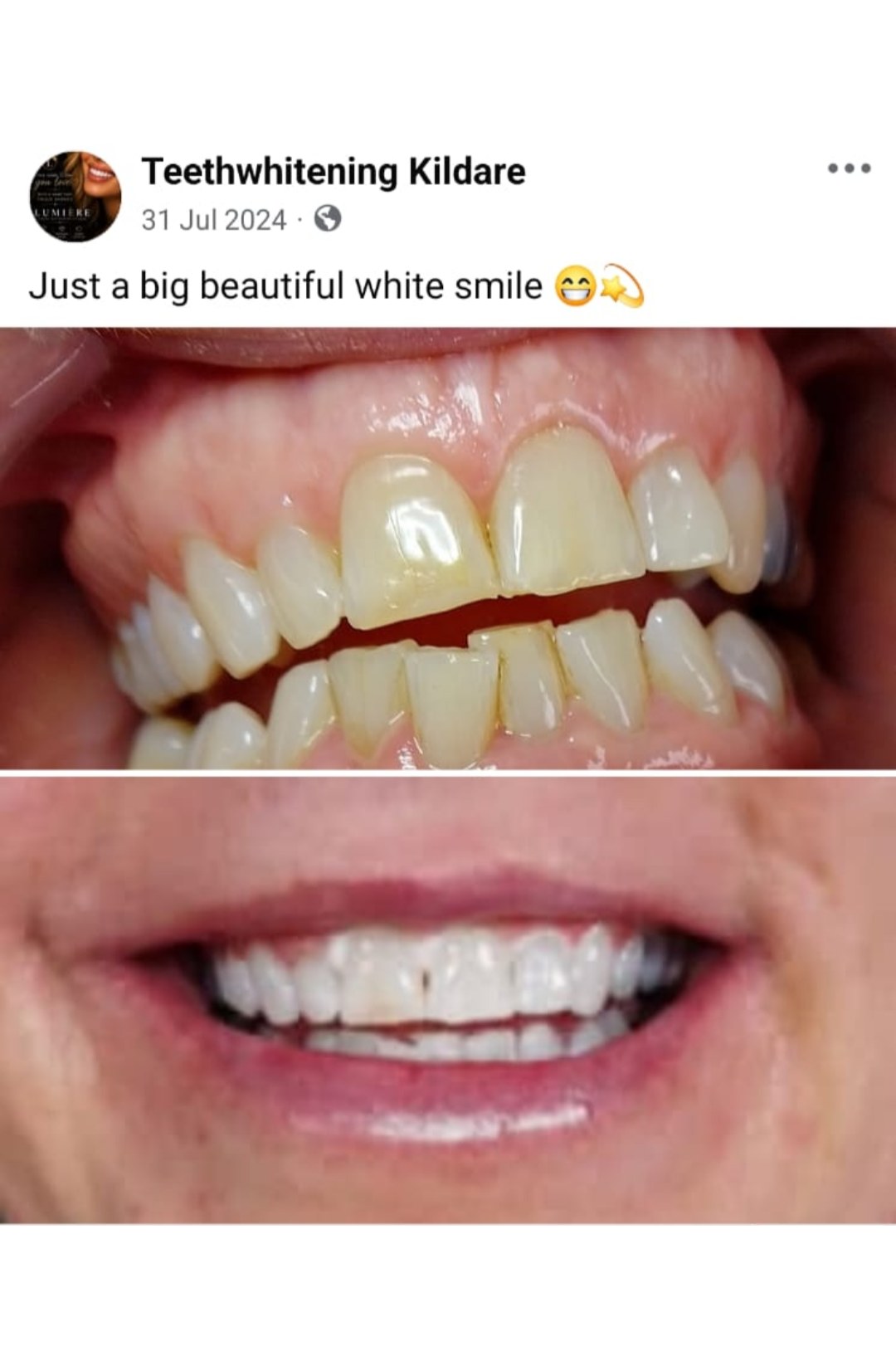 Lumiere teeth whitening before and after posted on Facebook as Teethwhitening Kildare on 31 Jul 2024. Just a big beautiful white smile.