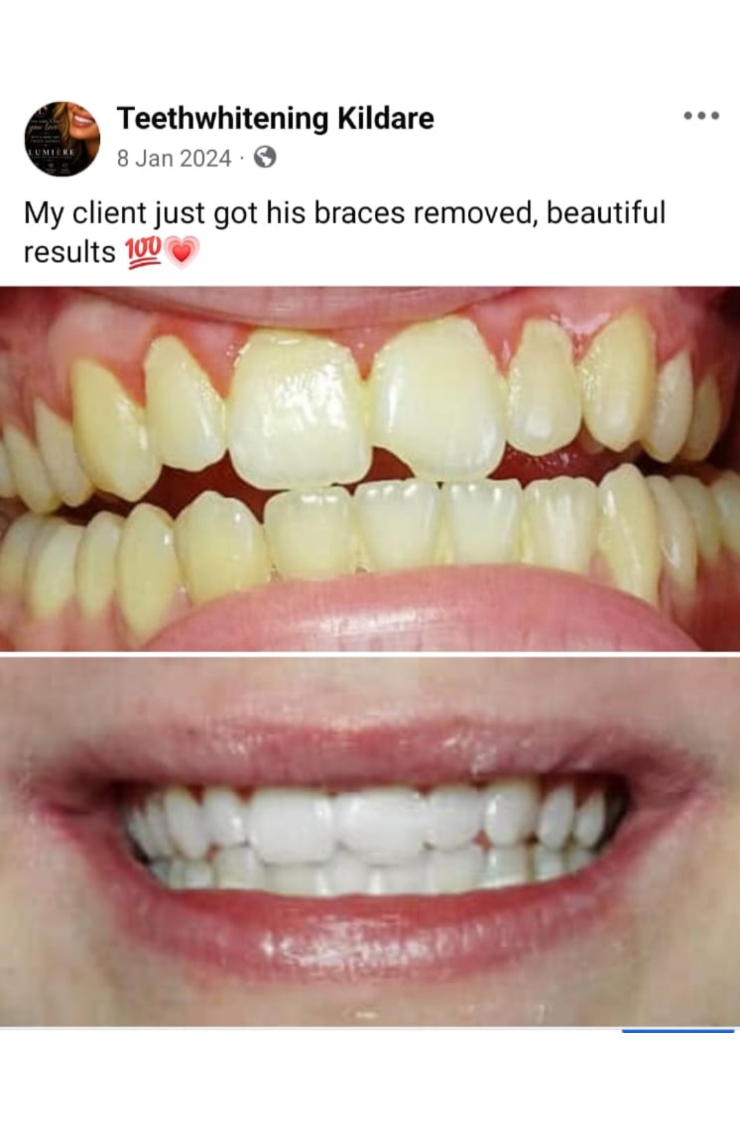 Lumiere teeth whitening before and after posted on Facebook as Teethwhitening Kildare on 8 Jan 2024. Braces just off — beautiful results.