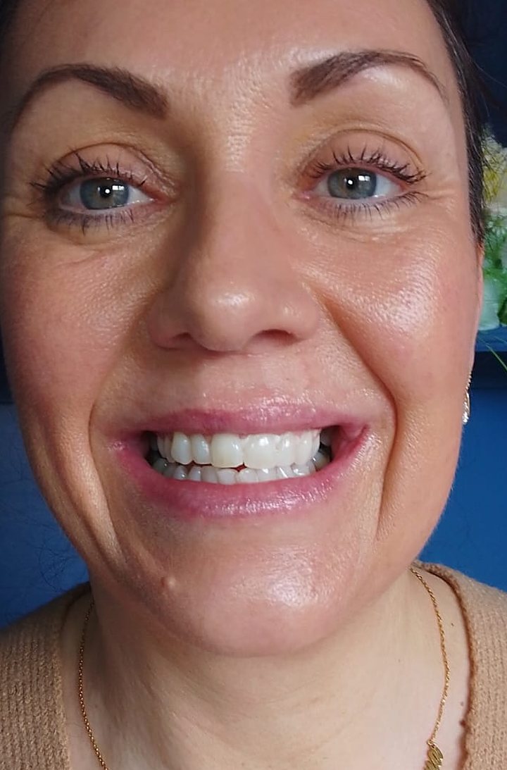 Smiling Lumiere client after teeth whitening at the Kildare studio