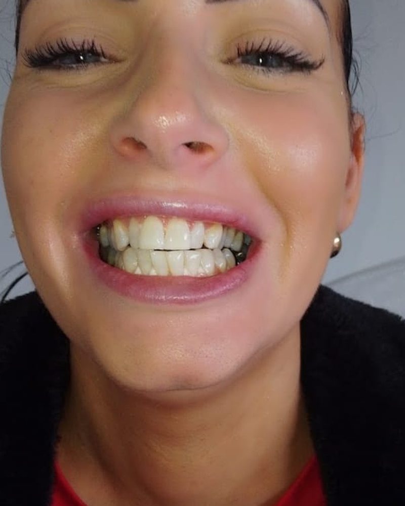 A smiling Lumiere teeth whitening client in Kildare.