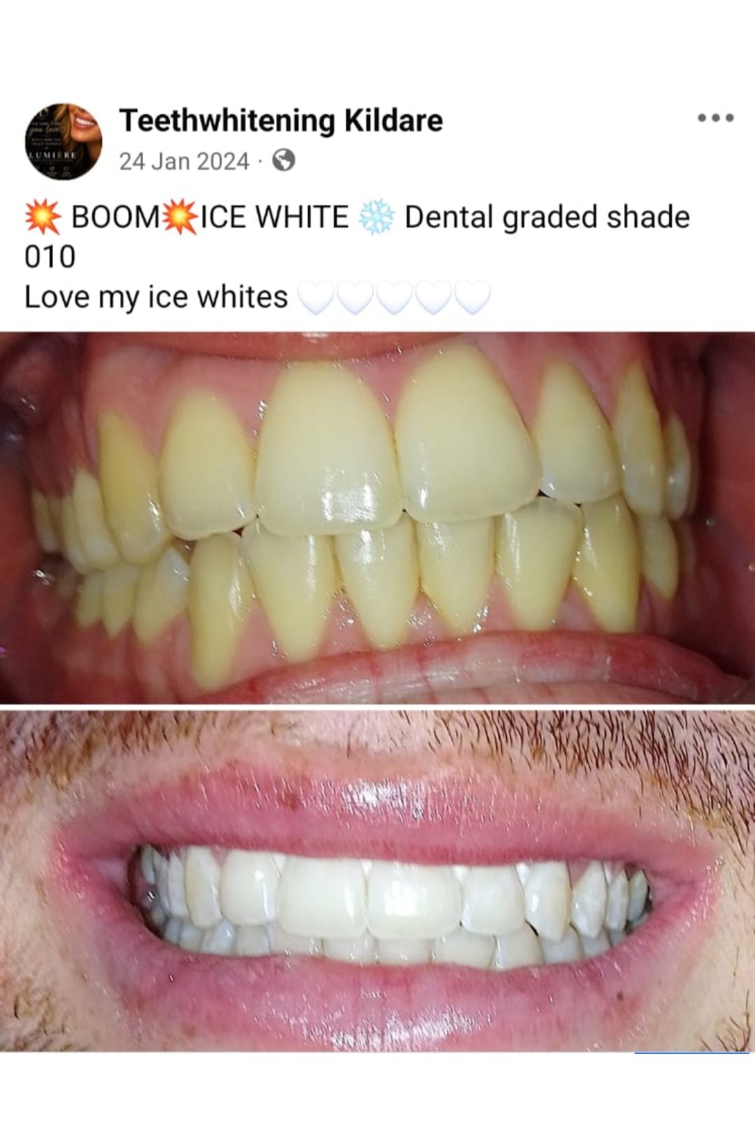 Lumiere teeth whitening before and after posted on Facebook as Teethwhitening Kildare on 24 Jan 2024. Ice white — dental graded shade 010.