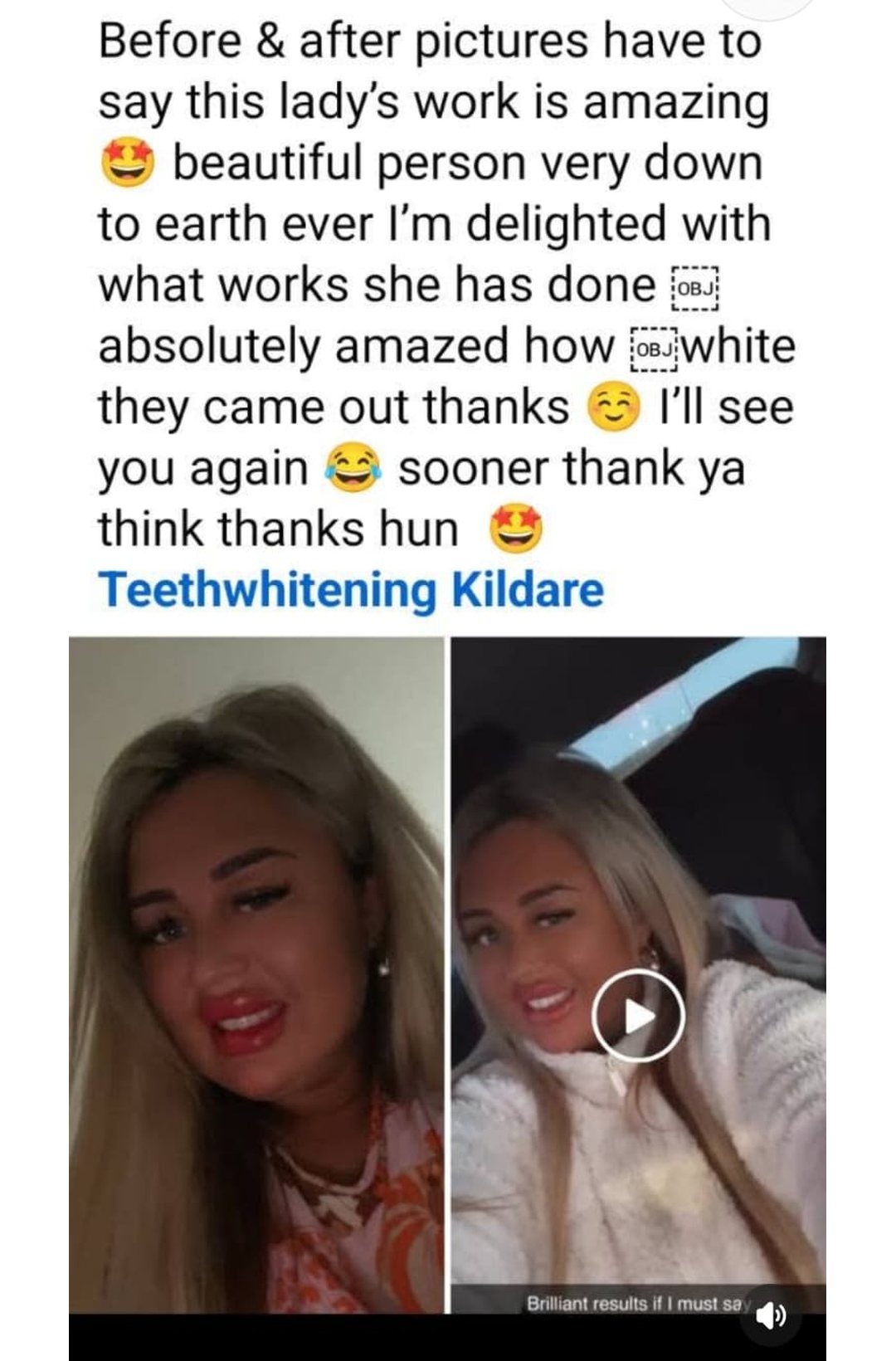 Lumiere teeth whitening before and after posted on Facebook as Teethwhitening Kildare on 2024. "Absolutely amazed how white they came out."