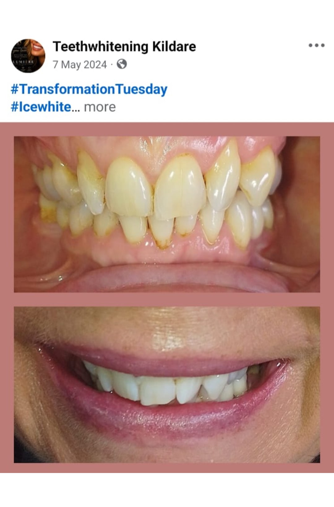 Lumiere teeth whitening before and after posted on Facebook as Teethwhitening Kildare on 7 May 2024. Transformation Tuesday — ice white.