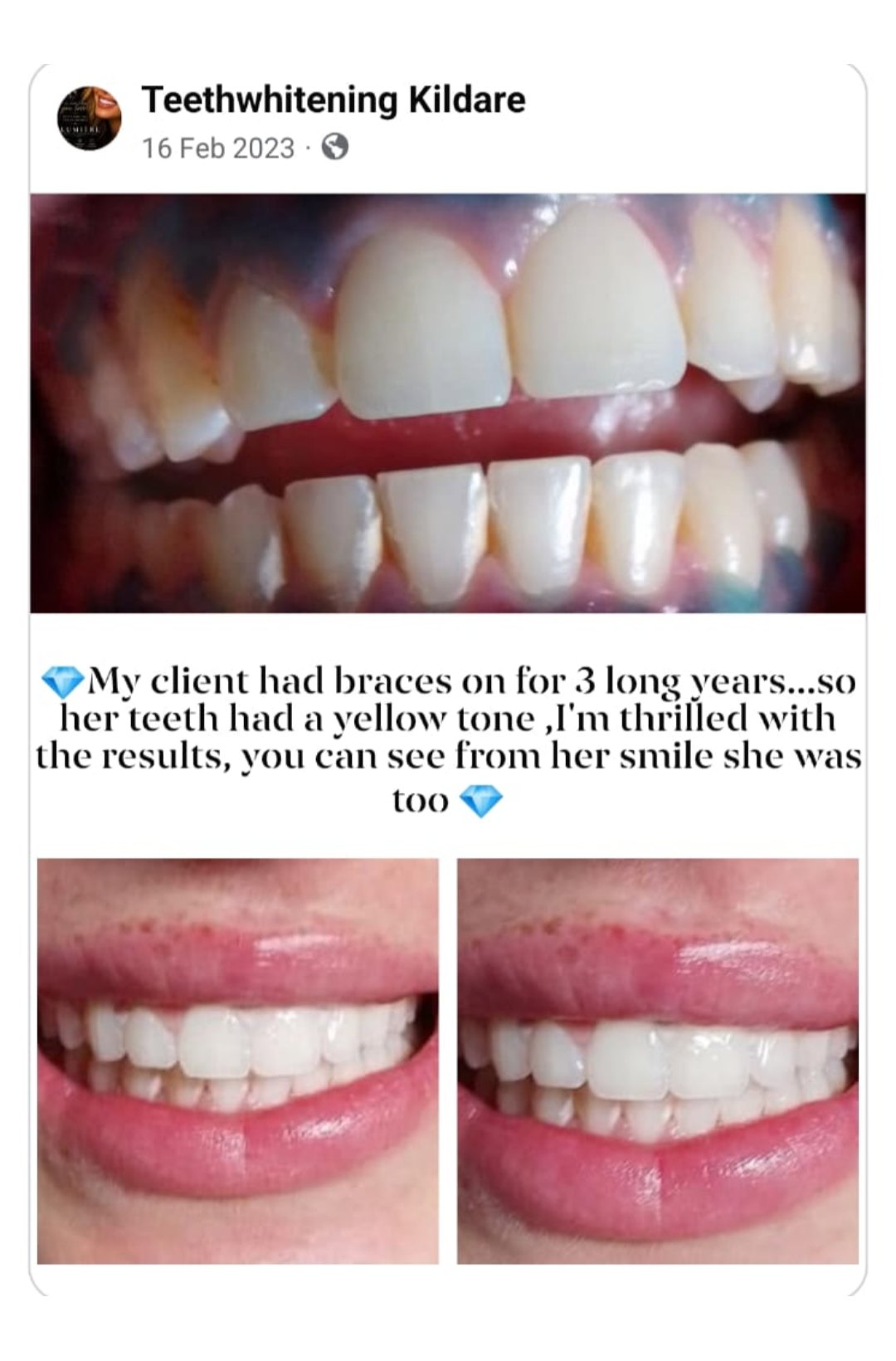 Lumiere teeth whitening before and after posted on Facebook as Teethwhitening Kildare on 16 Feb 2023. Three years in braces left a yellow tone — thrilled with the result.
