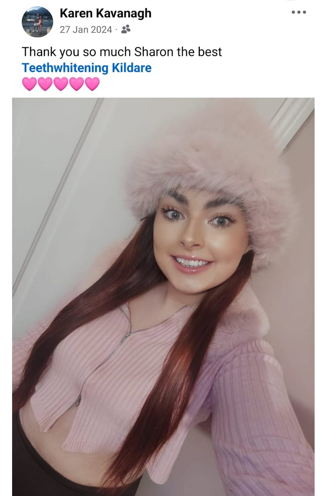 Lumiere teeth whitening before and after posted on Facebook as Teethwhitening Kildare on 27 Jan 2024. "Thank you so much Sharon the best." — Karen Kavanagh