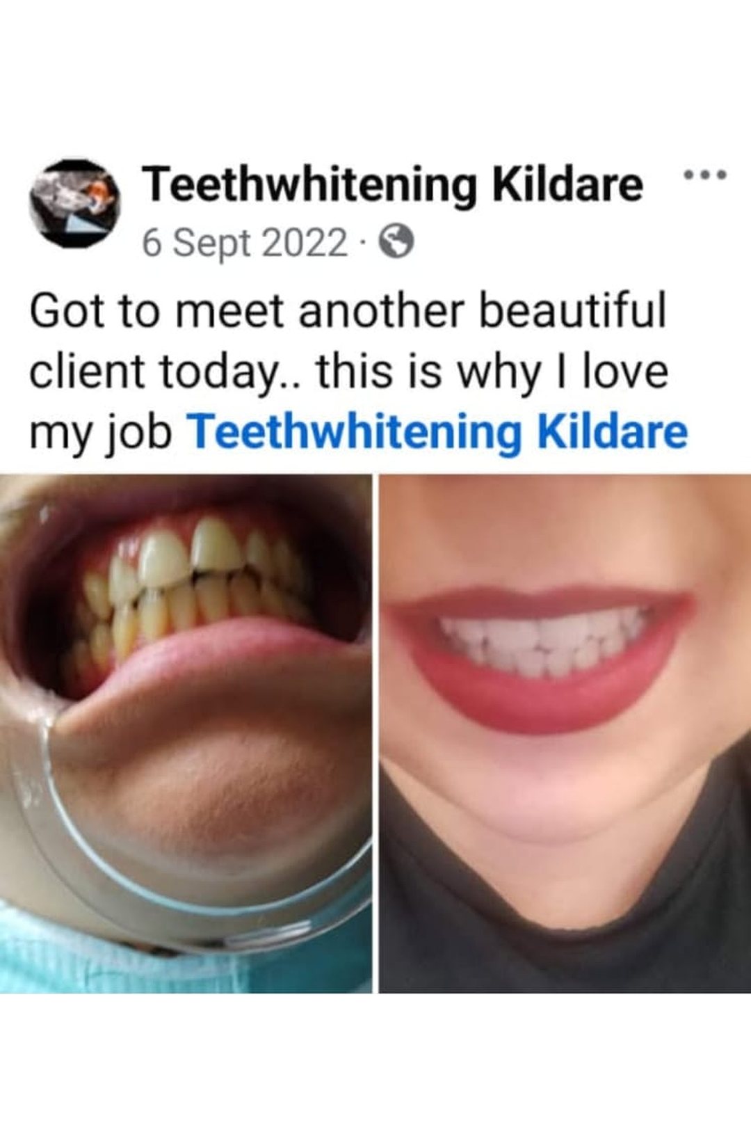 Lumiere teeth whitening before and after posted on Facebook as Teethwhitening Kildare on 6 Sept 2022. "This is why I love my job."
