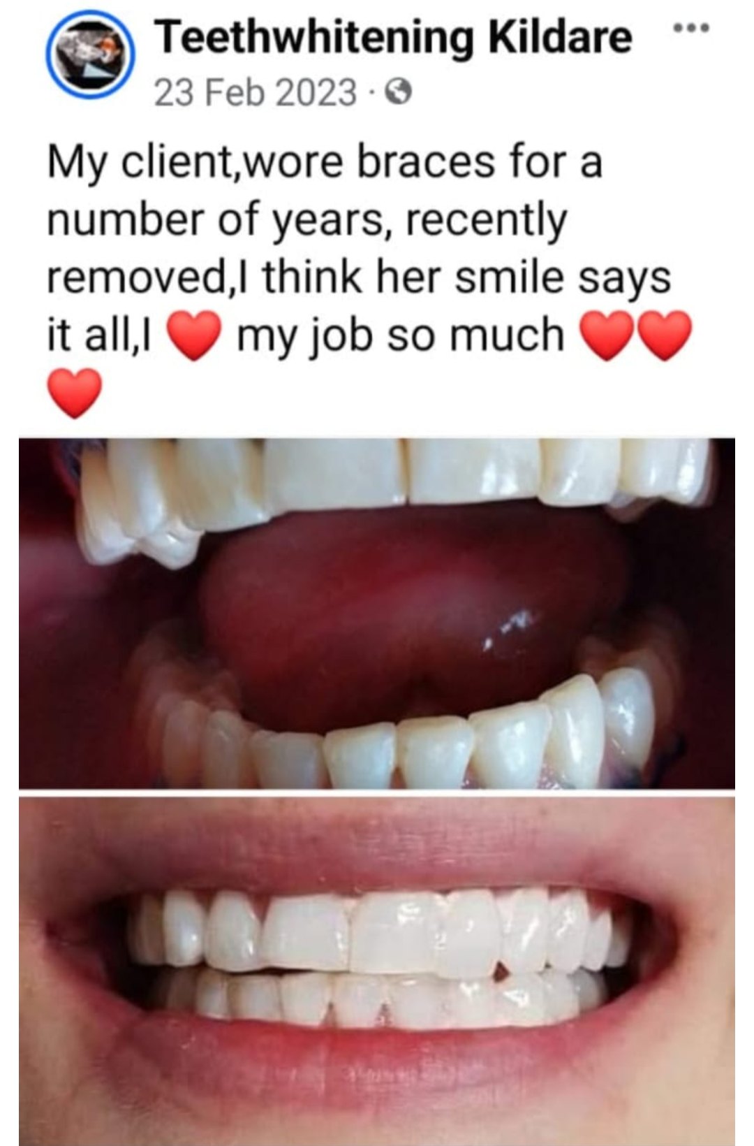 Lumiere teeth whitening before and after posted on Facebook as Teethwhitening Kildare on 23 Feb 2023. Braces recently removed — her smile says it all.