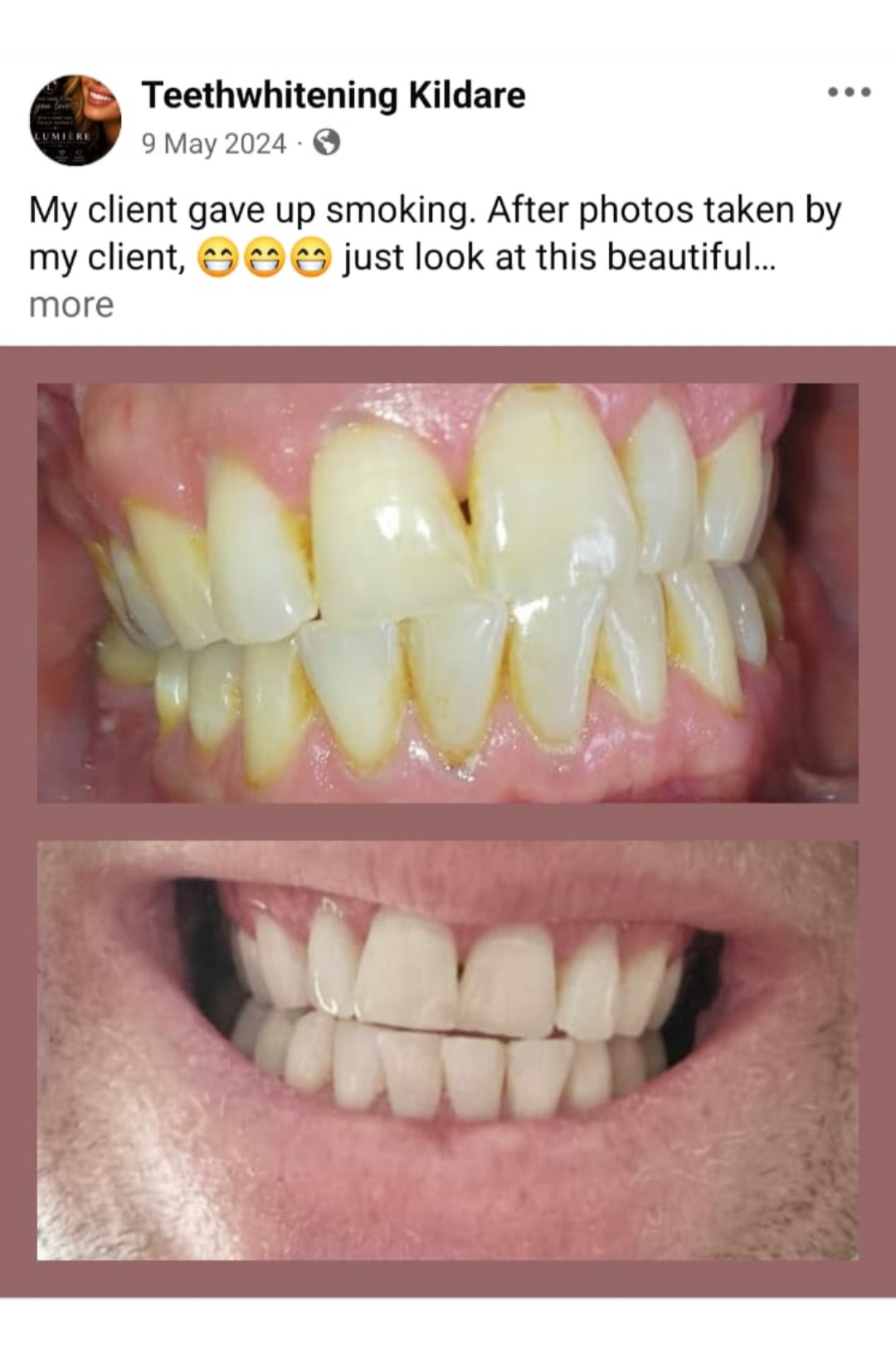 Lumiere teeth whitening before and after posted on Facebook as Teethwhitening Kildare on 9 May 2024. A client who gave up smoking, with after photos taken at home.