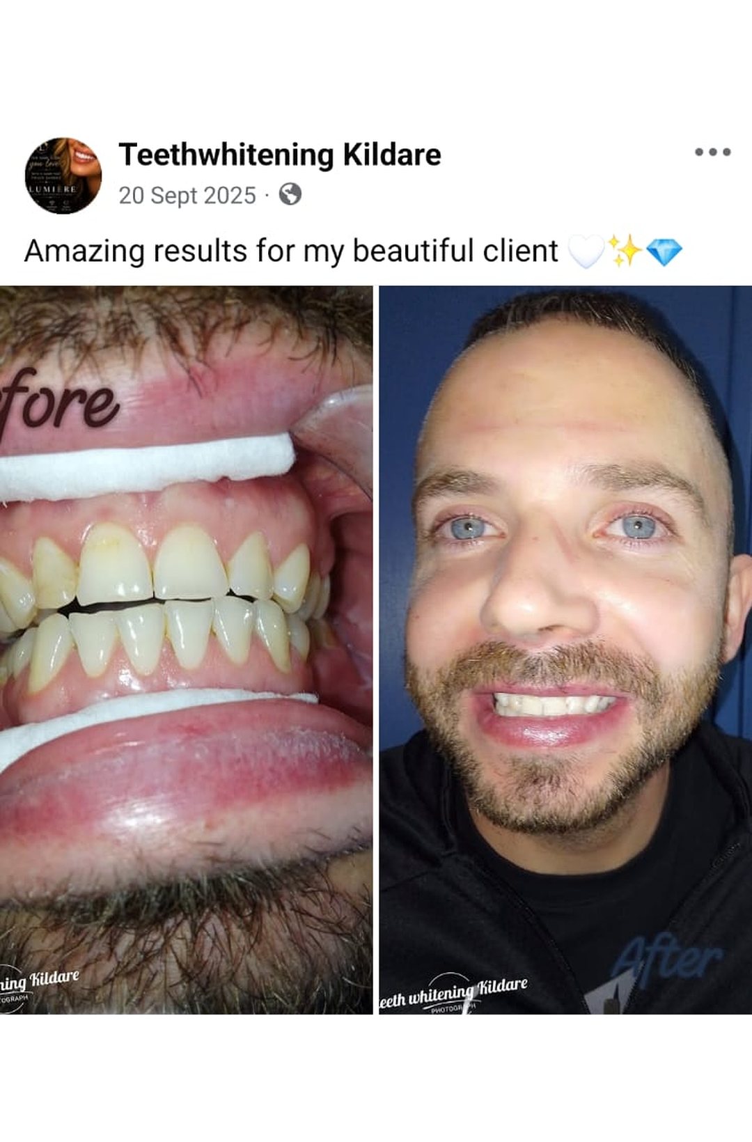 Lumiere teeth whitening before and after posted on Facebook as Teethwhitening Kildare on 20 Sept 2025. Amazing results for a beautiful client.