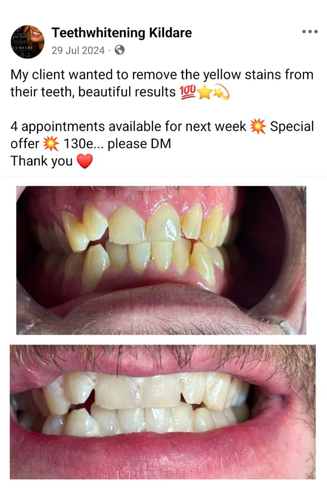 Lumiere teeth whitening before and after posted on Facebook as Teethwhitening Kildare on 29 Jul 2024. Stain removal with beautiful, natural brightness.