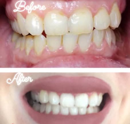 Real before and after teeth whitening — Top-Up Glow · Maynooth at Lumiere Kildare