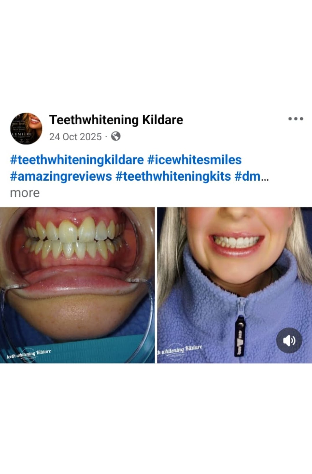 Lumiere teeth whitening before and after posted on Facebook as Teethwhitening Kildare on 24 Oct 2025. Ice white smiles from the Kildare studio.
