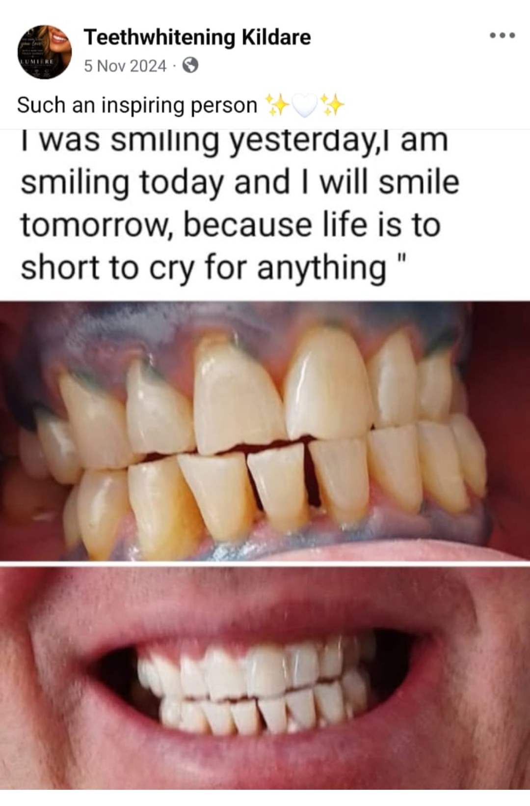 Lumiere teeth whitening before and after posted on Facebook as Teethwhitening Kildare on 5 Nov 2024. Smiling yesterday, today and tomorrow.