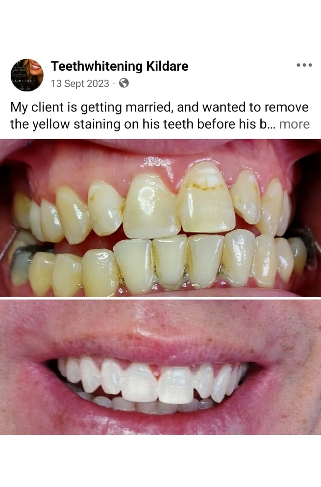 Lumiere teeth whitening before and after posted on Facebook as Teethwhitening Kildare on 13 Sept 2023. Yellow staining removed before his big day.