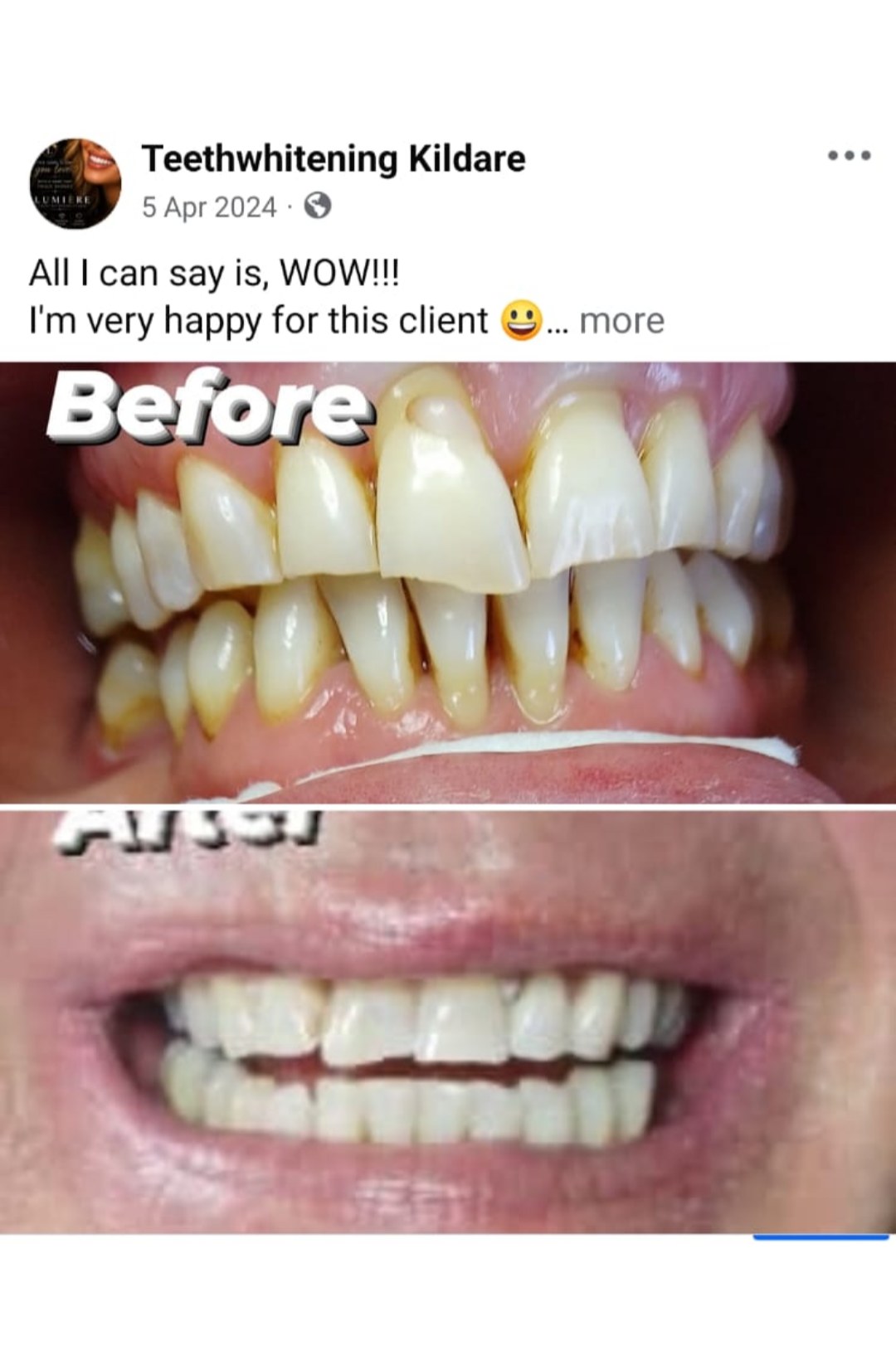 Lumiere teeth whitening before and after posted on Facebook as Teethwhitening Kildare on 5 Apr 2024. All I can say is wow — a very happy client.