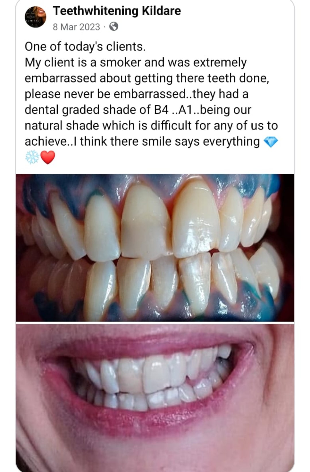 Lumiere teeth whitening before and after posted on Facebook as Teethwhitening Kildare on 8 Mar 2023. From a dental shade of B4 to A1 — never be embarrassed.