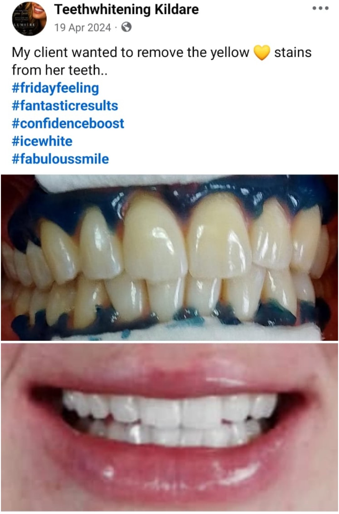 Lumiere teeth whitening before and after posted on Facebook as Teethwhitening Kildare on 19 Apr 2024. Yellow stains removed — a fabulous ice white smile.