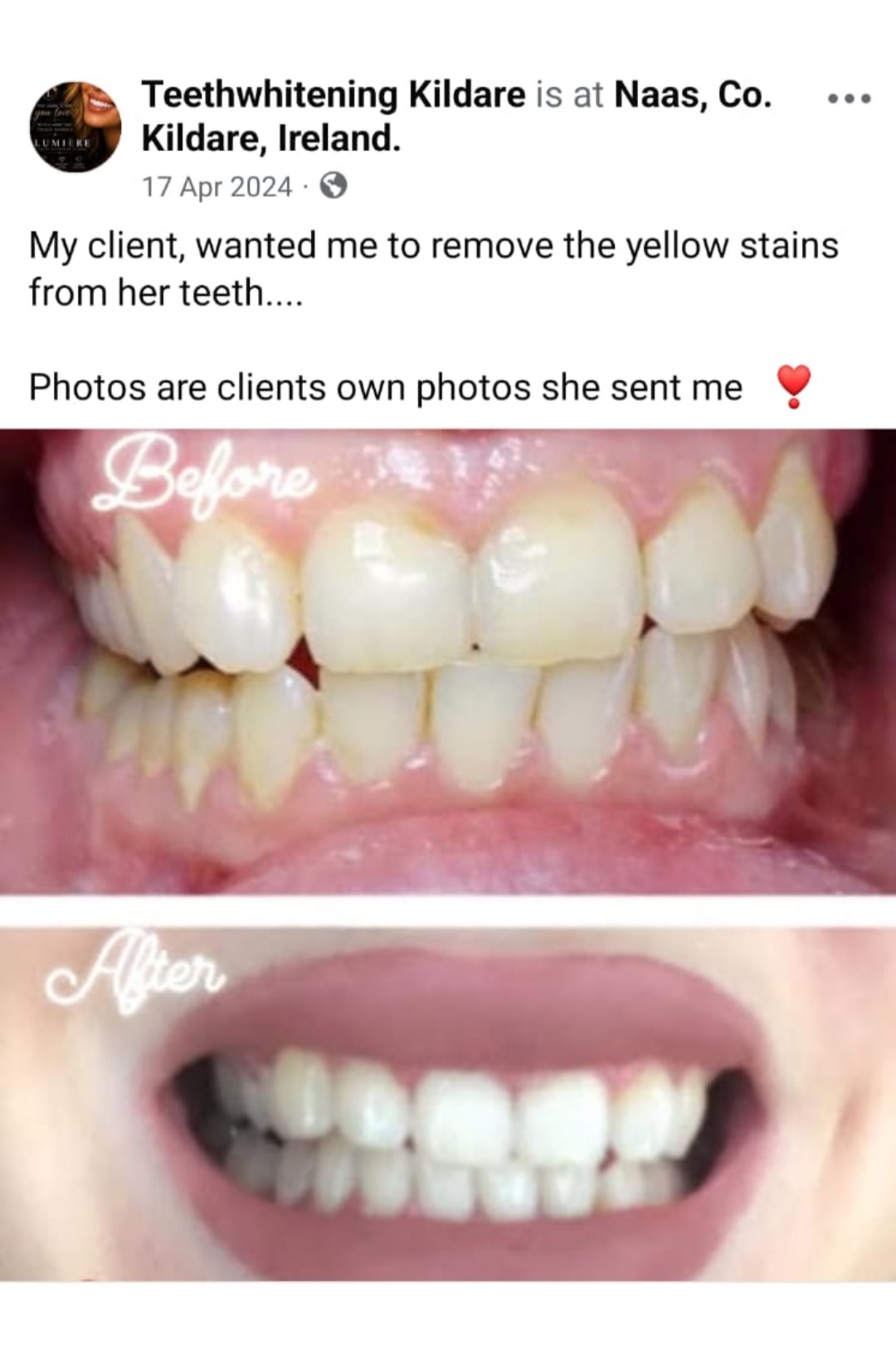 Lumiere teeth whitening before and after posted on Facebook as Teethwhitening Kildare on 17 Apr 2024. Yellow staining lifted for a client in Naas, Co. Kildare.
