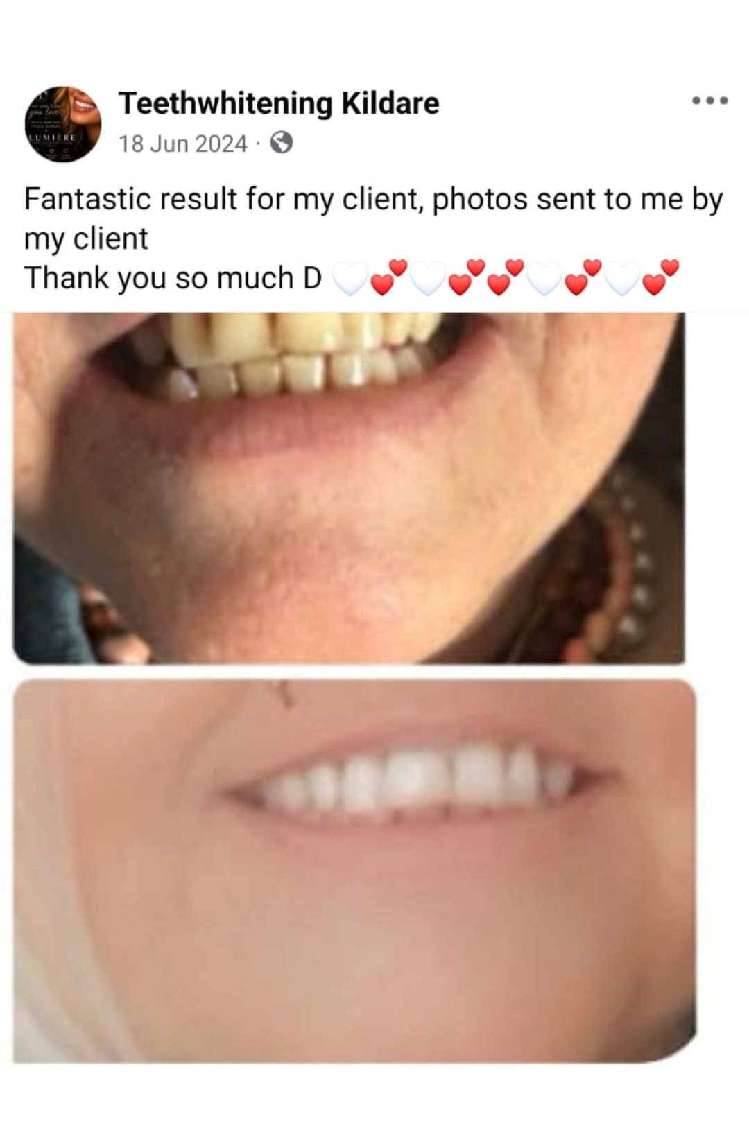 Lumiere teeth whitening before and after posted on Facebook as Teethwhitening Kildare on 18 Jun 2024. A fantastic result, photos sent in by the client.