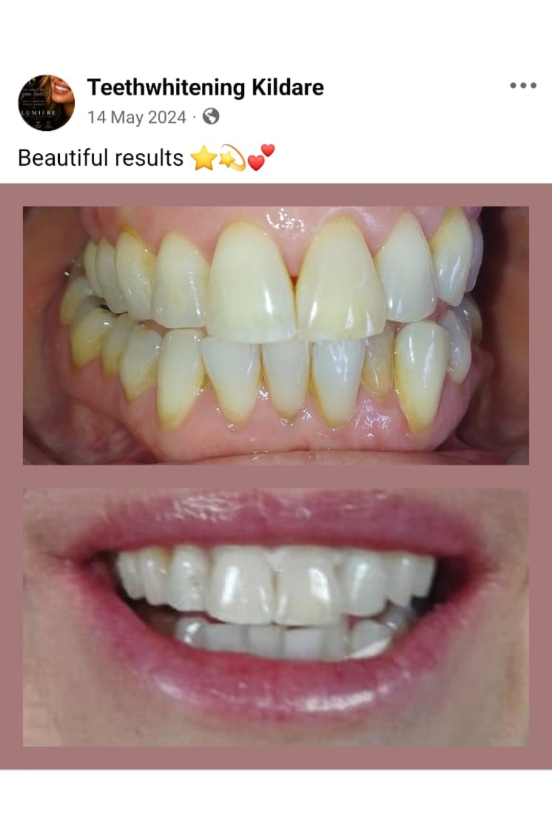 Lumiere teeth whitening before and after posted on Facebook as Teethwhitening Kildare on 14 May 2024. Beautiful results.