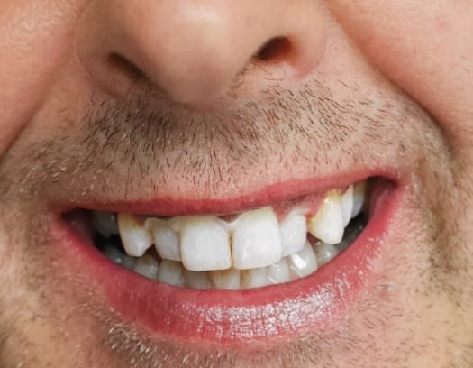 After teeth whitening at Lumiere — client who was a heavy smoker and tea and coffee drinker