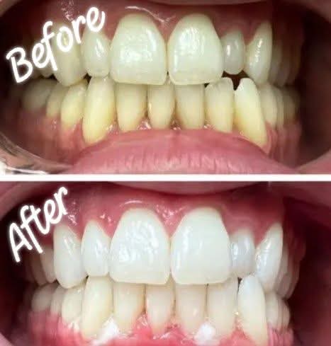 Real before and after teeth whitening — Signature Lumiere · Naas at Lumiere Kildare