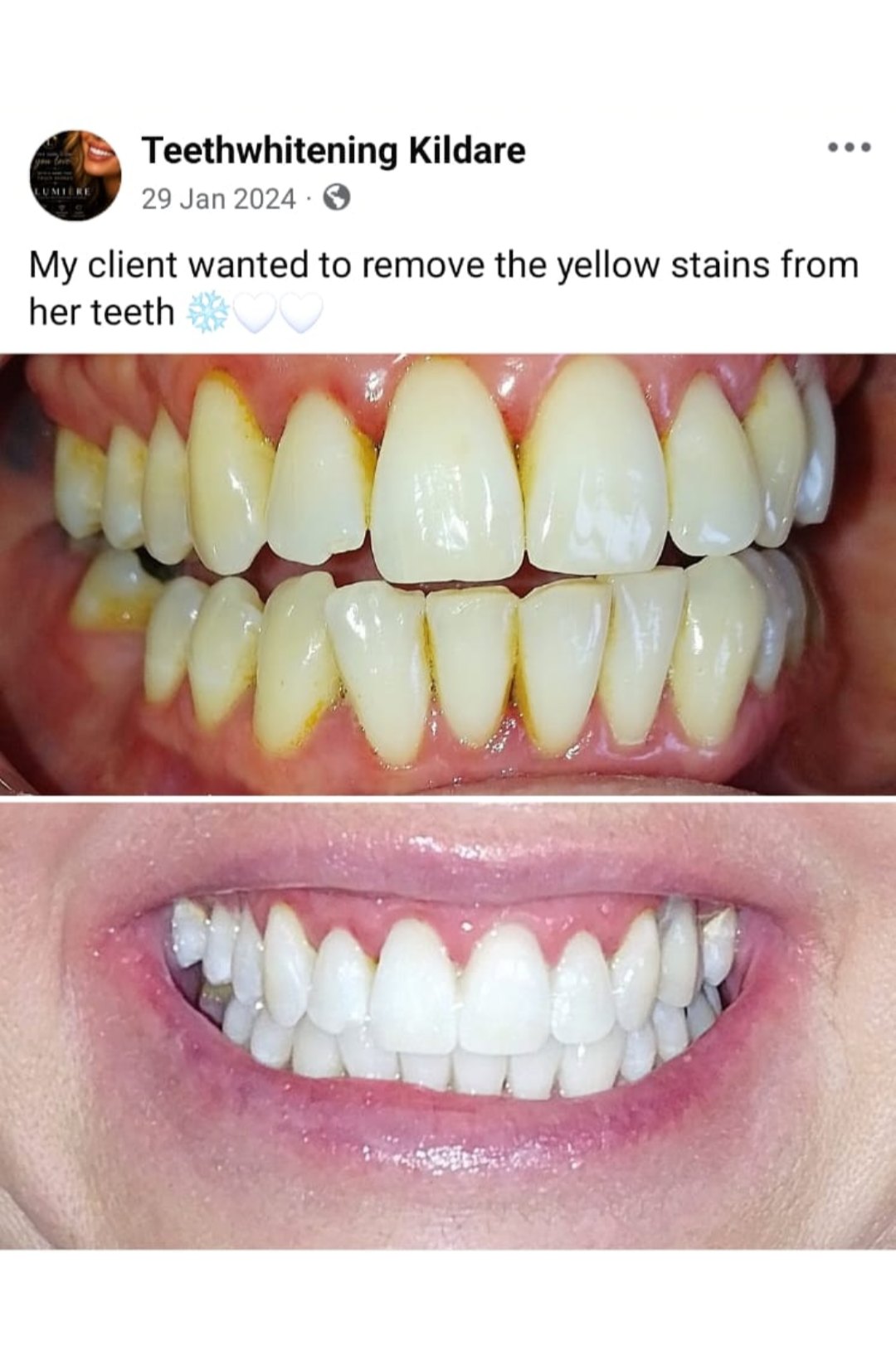 Lumiere teeth whitening before and after posted on Facebook as Teethwhitening Kildare on 29 Jan 2024. Yellow stains removed from a client's teeth.