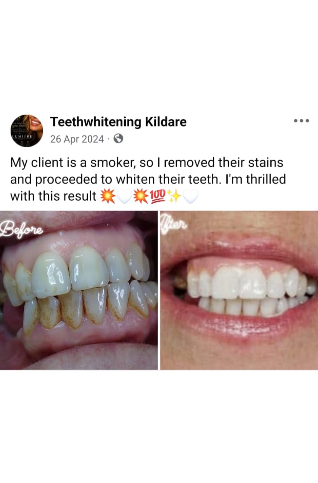 Lumiere teeth whitening before and after posted on Facebook as Teethwhitening Kildare on 26 Apr 2024. Stains removed for a smoker, then whitened.
