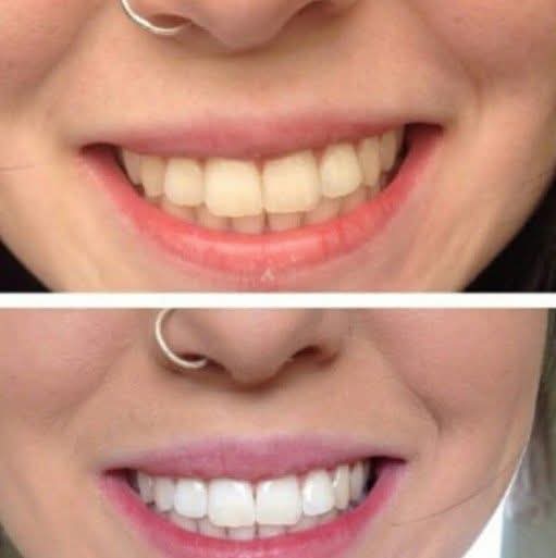 Real before and after teeth whitening — Signature Lumiere · Newbridge at Lumiere Kildare