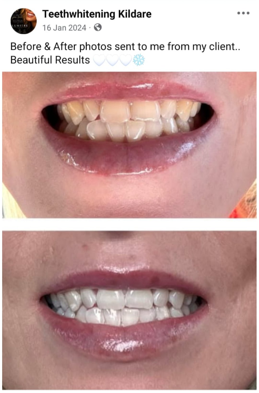 Lumiere teeth whitening before and after posted on Facebook as Teethwhitening Kildare on 16 Jan 2024. Before and after photos sent in by the client.