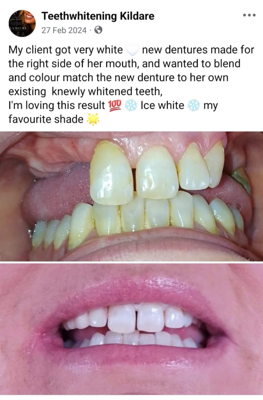 Lumiere teeth whitening before and after posted on Facebook as Teethwhitening Kildare on 27 Feb 2024. A new denture colour-matched to freshly whitened teeth — ice white.