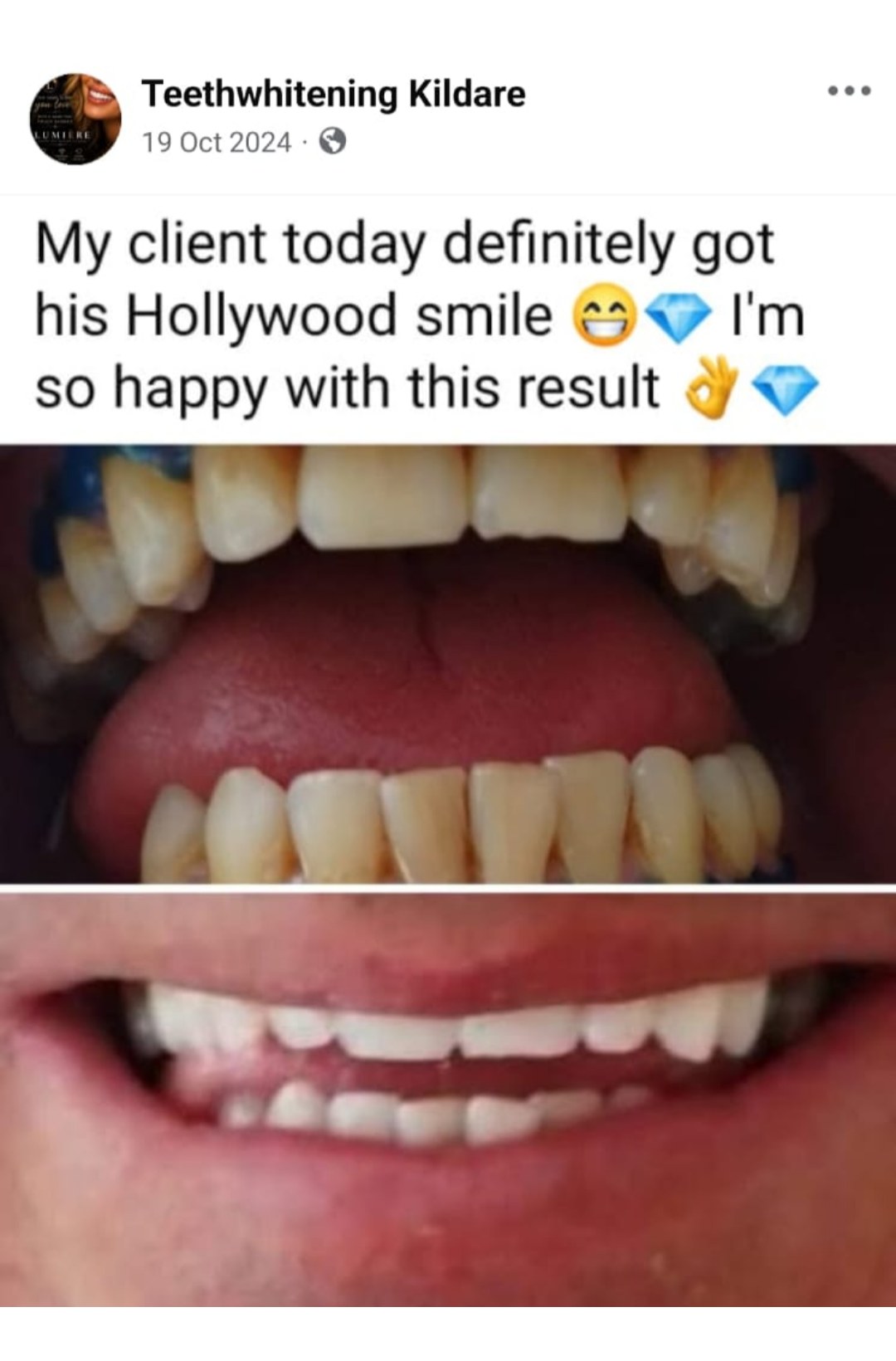Lumiere teeth whitening before and after posted on Facebook as Teethwhitening Kildare on 19 Oct 2024. A Hollywood smile for a very happy client.