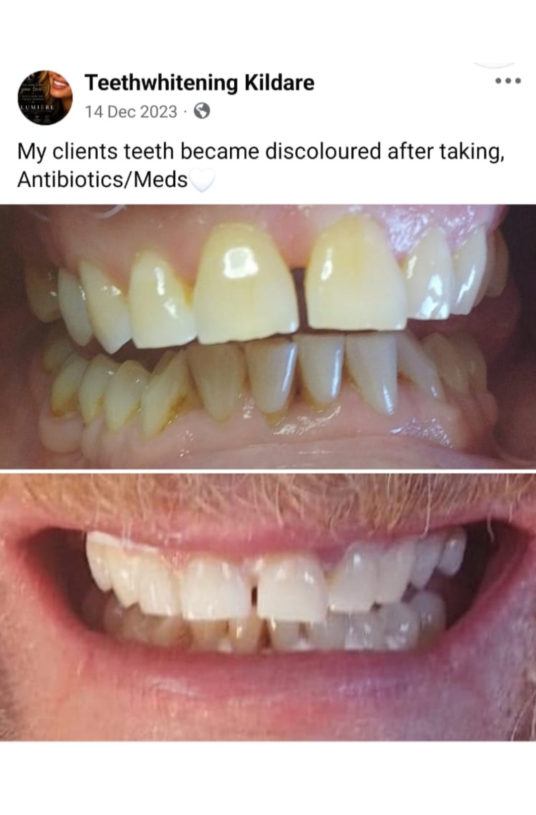 Lumiere teeth whitening before and after posted on Facebook as Teethwhitening Kildare on 14 Dec 2023. Teeth discoloured after antibiotics, brightened back up.