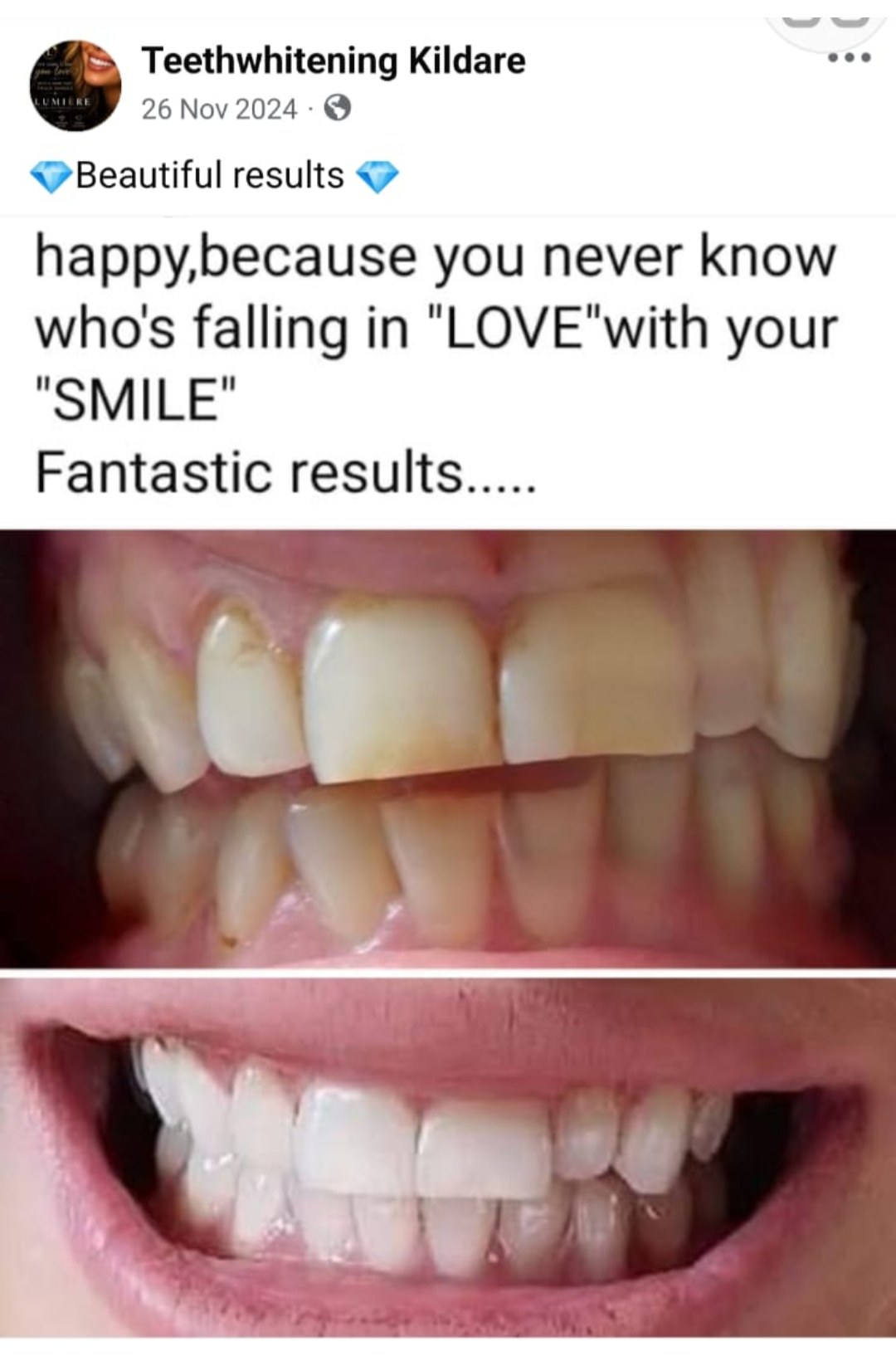 Lumiere teeth whitening before and after posted on Facebook as Teethwhitening Kildare on 21 Nov 2024. Before and after, sent in by a delighted client.