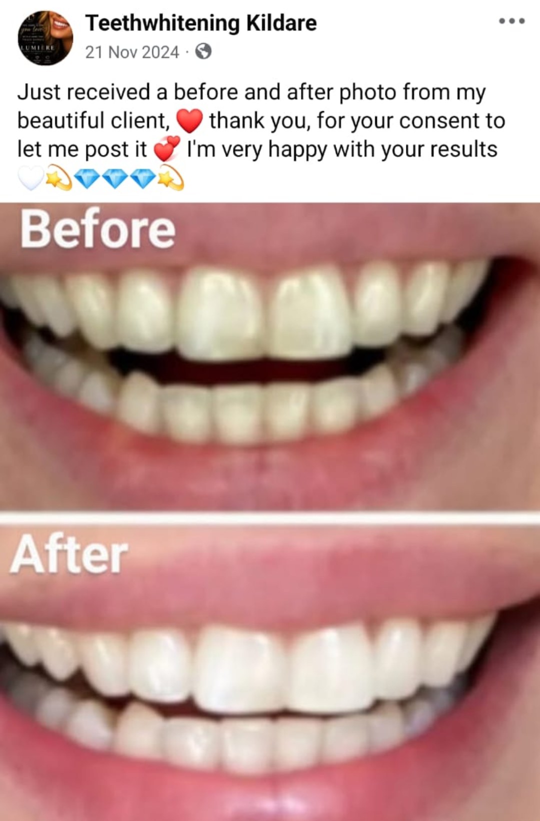 Lumiere teeth whitening before and after posted on Facebook as Teethwhitening Kildare on 26 Nov 2024. Beautiful results, shared with the client's consent.